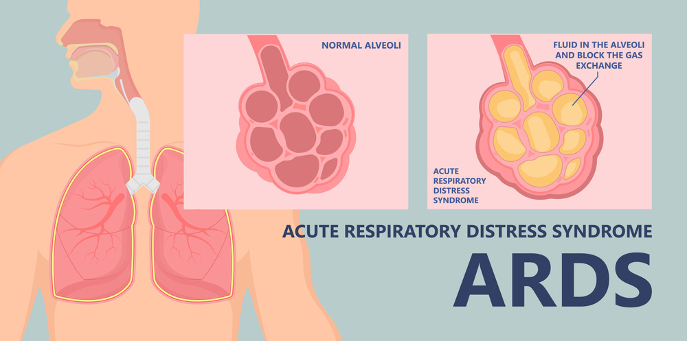 ARDS Treatment in Mumbai