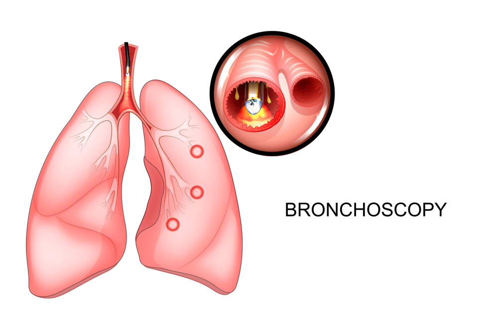 Bronchoscopy Procedure conducted by Dr. Dhiraj Jain in Mumbai