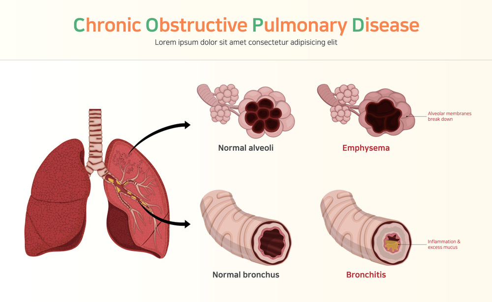 Best COPD Treatment in Mumbai by Dr. Dhiraj Jain 