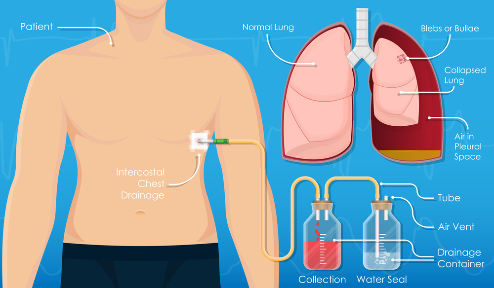 Intercostal Drainage or Chest Drain Procedure in Mumbai .