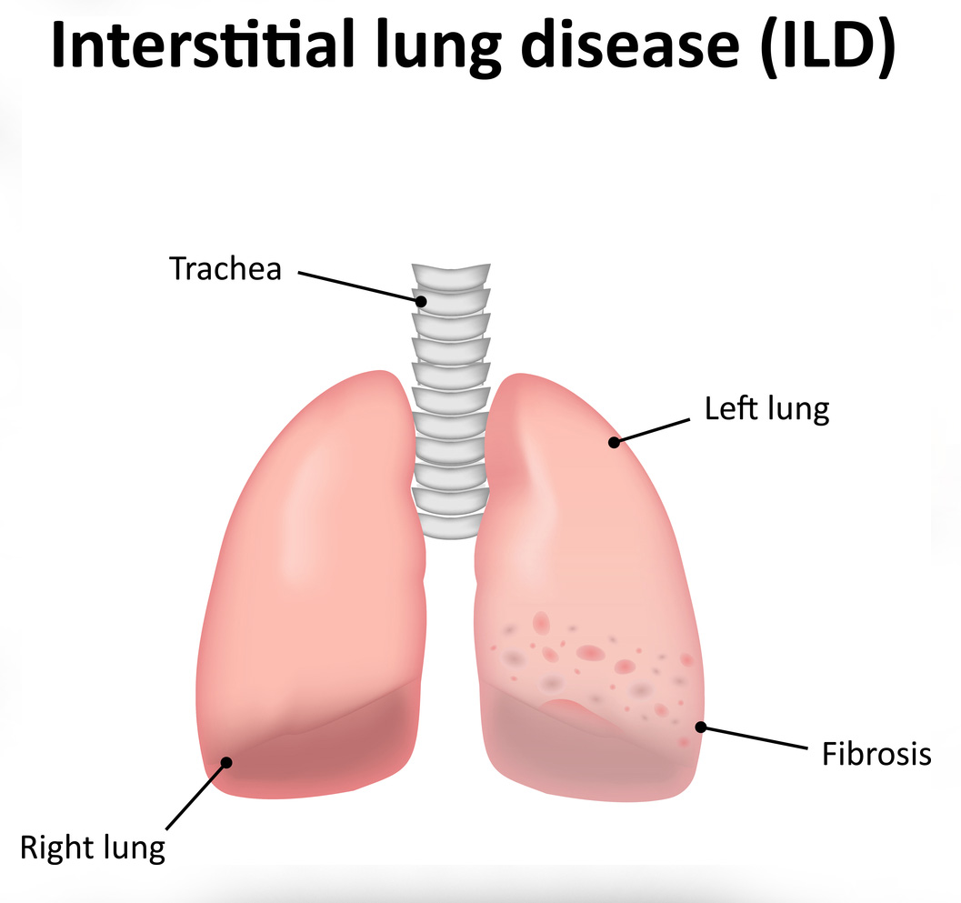 Pulmonologist For Interstitial Lung Disease Treatment