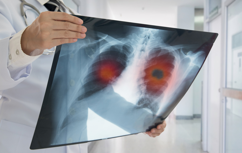 Lung Cancer Diagnostic Guidance Centre in Mumbai