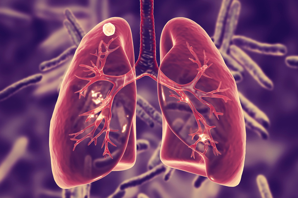 Best Pulmonologist For Lymph Node Swelling in Mumbai 