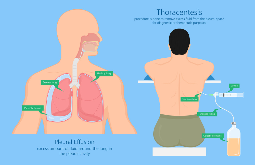 Pleural Effusions and Empyema Treatment by Dr.Dhiraj Jain