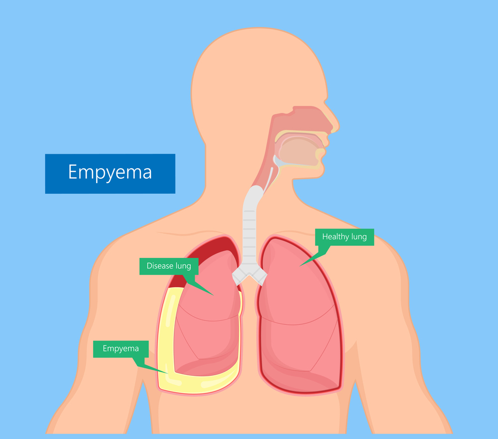 Pleural Tapping or Thoracentesis conducted by Dr.Dhiraj Jain 