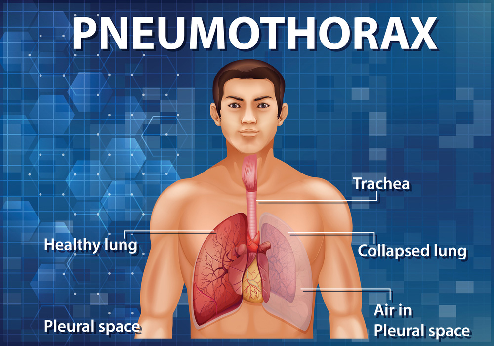 Best Pneumothorax Treatment by Dr.Dhiraj Jain