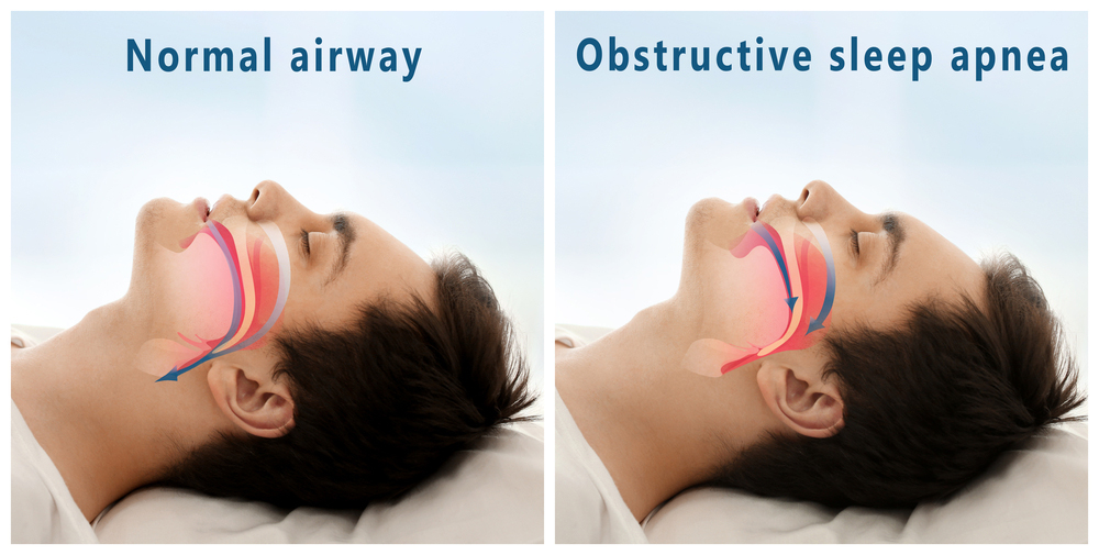 Obstructive Sleep Apnea Treatment in Mumbai, Dr. Dhiraj Jain