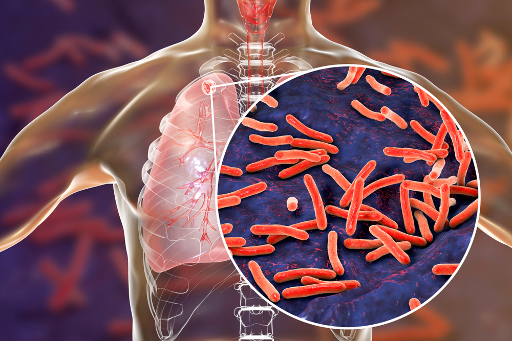 Best Doctor for treating Tuberculosis TB in Mumbai by Dr. Dhiraj Jain